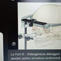 UPDATE 08.05.2025 – Elena urmează să treacă printr-o intervenție chirurgicală