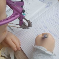 UPDATE 10.07.2025 –  Ajut-o pe Elena să ajungă lunar la reglaje în Turcia